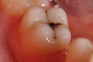 Ząb przed leczeniem