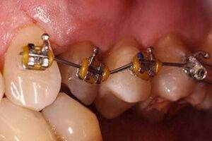 Leczenie ortodontyczne - przed
