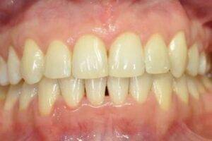 Leczenie ortodontyczne - po