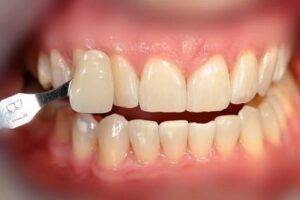 Wybielanie zębów - po