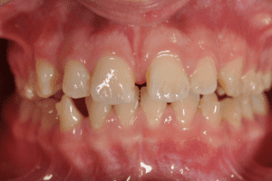 Przed leczeniem ortodontycznym Invisalign