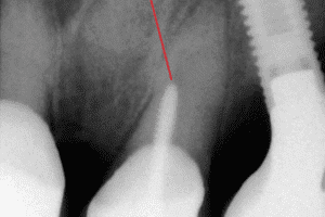 Endodoncja pod mikroskopem - przed