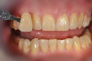 Wybielanie zębów - przed